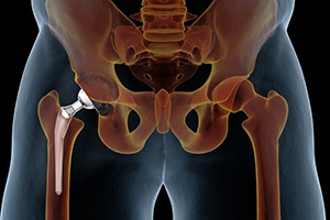 5 Things to Know About Hip Replacement Surgery