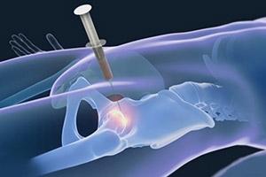 Benefits of Stem Cell Therapy for Hip Recovery