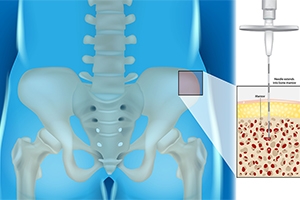 Beyond the Injury: How Microfracture Surgery Is Changing Hip Cartilage Regeneration