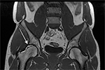 Can a Hip Labral Tear Be Worse Than an MRI Shows?
