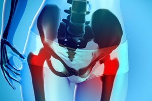 Can Stem Cell Therapy Help Avoid Hip Replacement?
