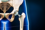 Can Technology Reduce Hip Replacement Failures? Here’s What the Evidence Shows
