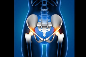 How to Prepare for a Periacetabular Osteotomy Procedure