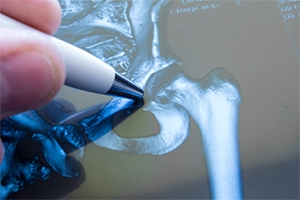 Same-Day Hip Replacement: The Anterior Approach Advantage
