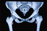 Same MRI, Different Symptoms: Why Imaging Alone Doesn’t Explain Hip Pain