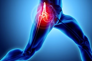 The Science Behind Hip Preservation: How We Save the Joint