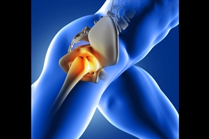 What Are the Advantages of Hip Arthroscopy?