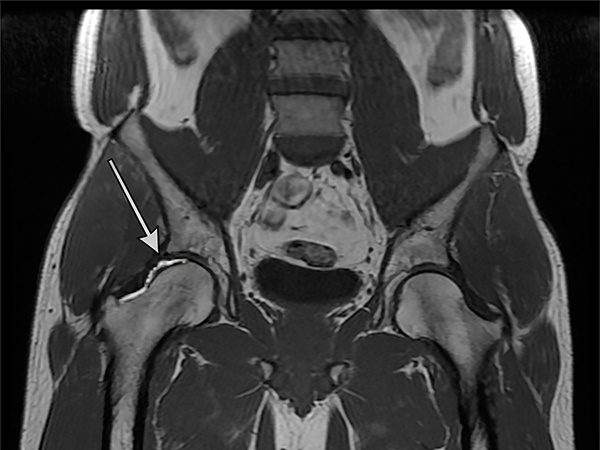 Can a Hip Labral Tear Be Worse Than an MRI Shows?