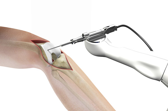 How Robotics is Changing Joint Replacement