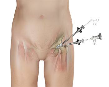 7 Treatments for Hip Arthritis