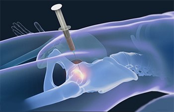Benefits of Stem Cell Therapy for Hip Recovery