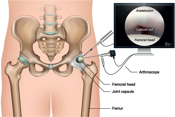 What is Hip Arthroscopy?
